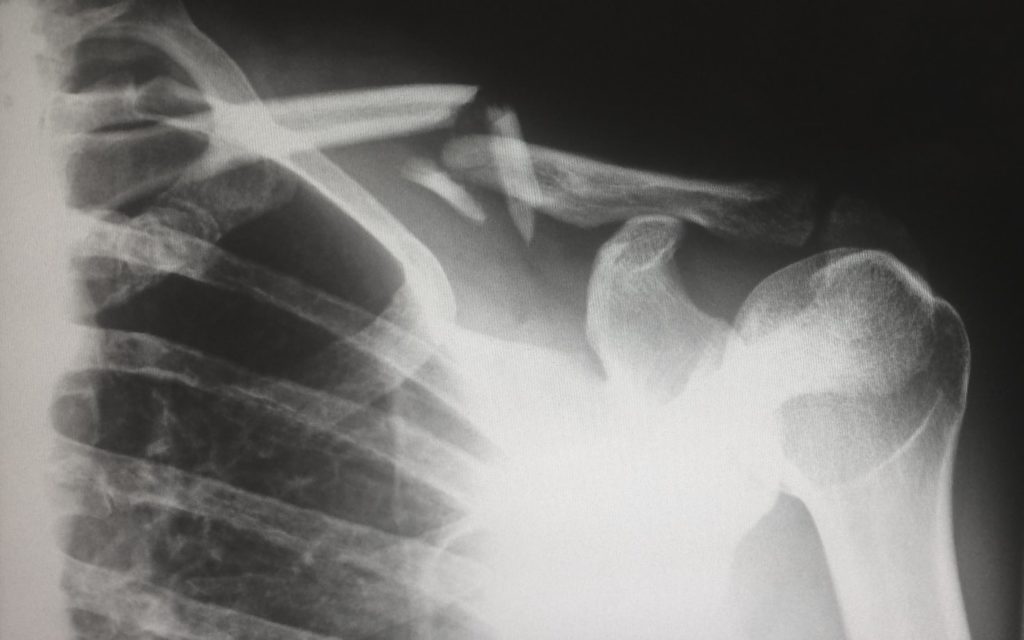 X-ray of a broken collar bone
